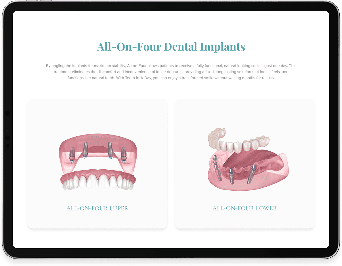 Tablet displaying a dental webpage with All-On-Four upper and lower implant illustrations.