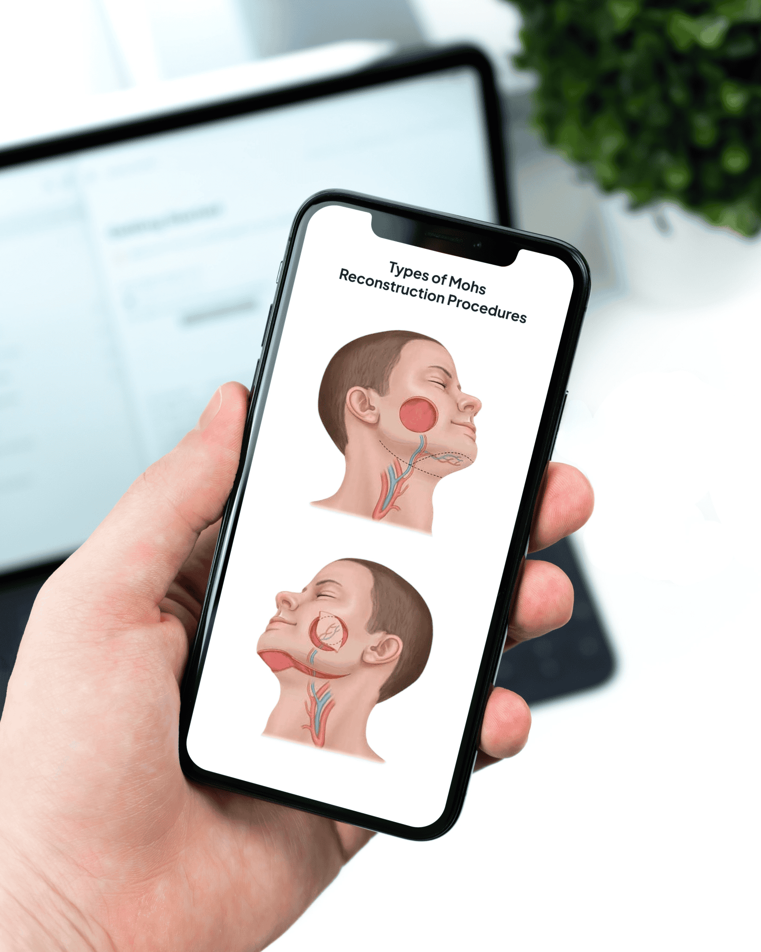 Smartphone displaying illustrated MOFS reconstruction procedure content for a medical practice website.